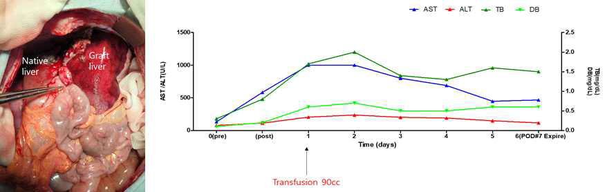 XL-26 의 수술 후 사진과 간기능 검사 수치 변화 추이
