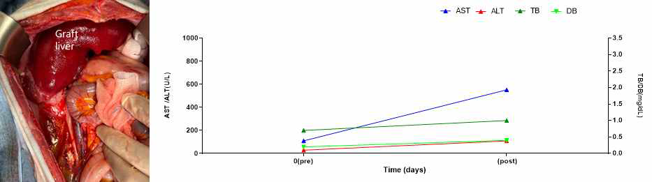XL-30 의 수술 후 사진과 간기능 검사 수치 변화 추이