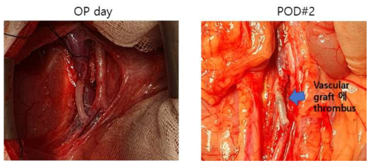 XVT01 수술 후 사진과 2일차 혈관 내 혈전 사진
