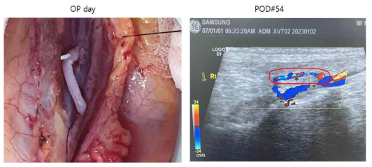 XV02 수술 후 사진과 54일째 초음파 사진. 초음파상 혈관이식편의 혈류가 잘 유지되고 있는 것을 확인하였음.