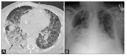 좌측 폐상엽에 발생한 바이러스성 폐렴의 흉부 CT (A)와 흉부 X-ray 소견 (B). 바이러스 성 폐렴을 진단되어 감염 확진 5일 후 환자 사망함