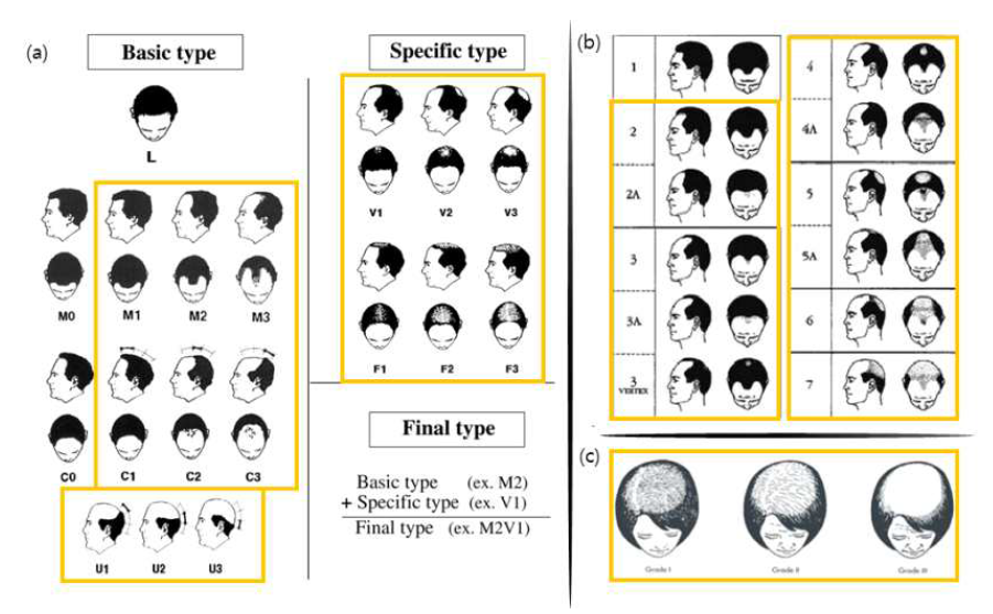 탈모군 선정 기준 (a) Basic and specific (BASP) classification (b) Norwood-Hamilton classification (c) Ludwig classification