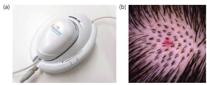 (a) FolliscopeⓇ5.0(LeadM, Korea) (b) 사진 예시(피험자번호: CT22-1000-S13)(배율 x14)