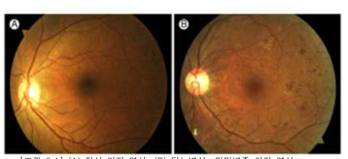 (A) 정상 안저 영상, (B) 당뇨병성 망막병증 안저 영상