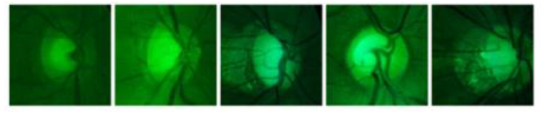 Red channel reduction을 진행한 Optic Disc 사진