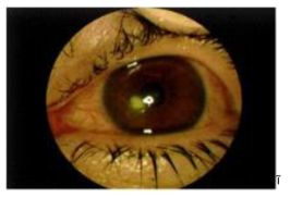 Corneal Ulcer