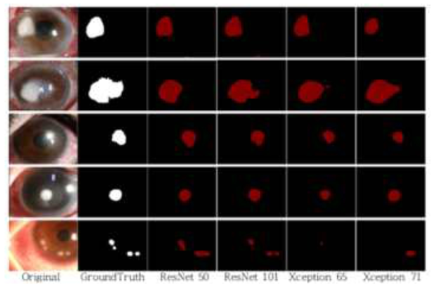 DeepLab을 이용한 각막궤양 영역 검출 결과 이미지
