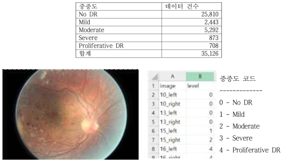 망막병증 안저 이미지(좌), 중증도 정보(중), 중증도 코드(우)