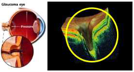 녹내장성 시신경 유두 함몰