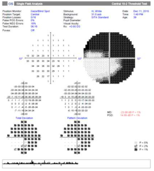 Humphrey visual field test