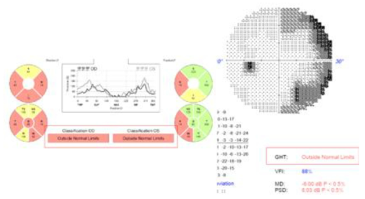 visual field test의 주요정보2