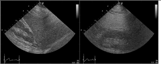 Zenodo Open source abdomen ultrasound image (좌) 정상 간, (우) 지방 간