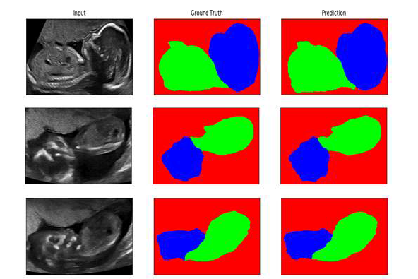 태아 초음파 관심 영역 분할 알고리즘 적용 예시. 첫 번째 열은 입력 영상, 두 번째 열은 Ground truth, 세 번째 열은 본 세부과제에서 개 발한 알고리즘의 적용 결과임.