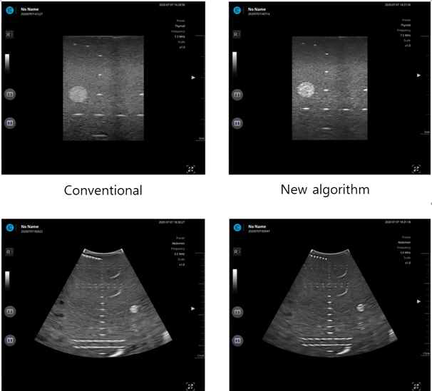 기존 알고리즘과 새로운 알고리즘의 초음파 영상 화질 비교