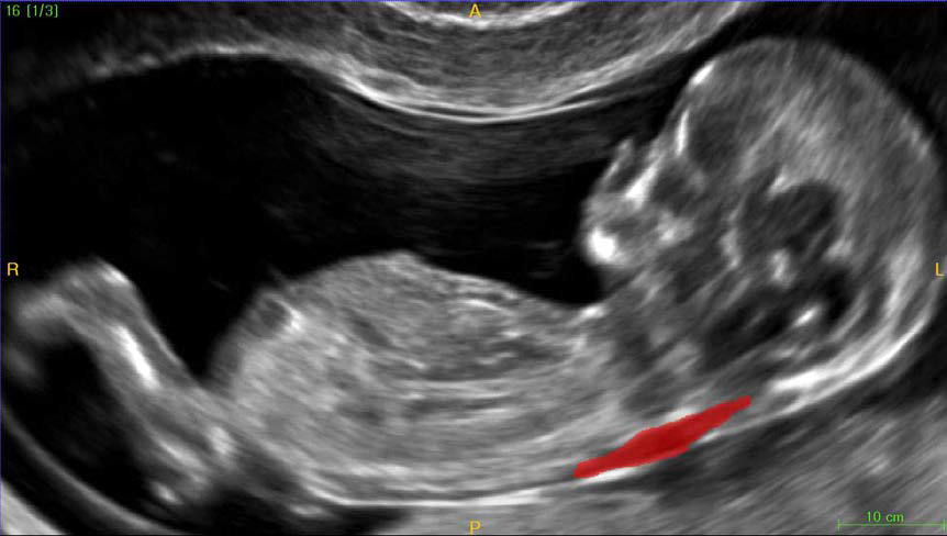 초음파 이미지로부터 Segmentation 된 태아 목덜미