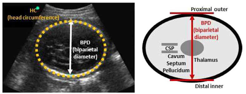 자궁 내 태아 성장 상태를 파악할 수 있는 영상 특징 중 머리 둘레와 아두대횡경치를 측정하는 방법