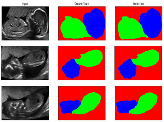 태아 초음파 관심 영역 분할 알고리즘 적용 예시. 첫 번째 열은 입력 영상, 두 번째 열은 Ground truth, 세 번째 열은 본 세부 과제에서 개발한 알고리즘의 적용 결과임.