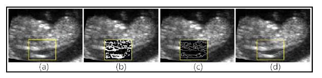 (a) Original ultrasound fetal ultrasound image, (b) Sobel Filter, (c) Canny Filter, (d) 개발된 NT 측정 알고리즘