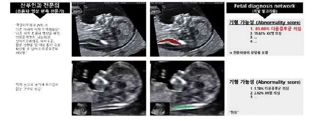 다운증후군 가능성을 판별하는 fetal diagnosis network의 XAI