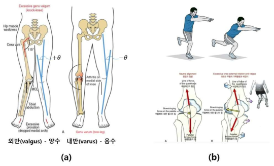 부상 위험도 측정 기준. (a) 직립 상태에서의 무릎 내/외반각 (b) Single leg squat를 수행할 때 무릎의 내/외반 각도 변화량