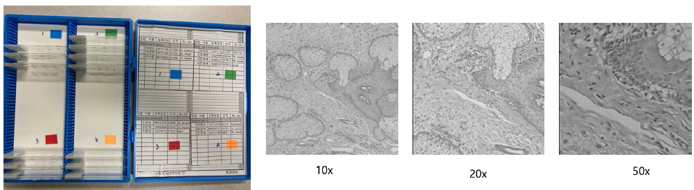 피부질환 조직 및 염색된 멜라닌 세포 영상