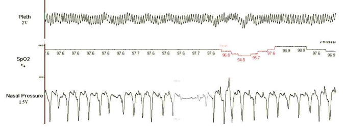 pulse oximetry (Plethysmography) 신호 기반의 수면무호흡 검출 특징