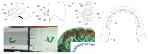 본 과제 주관기관에서 개발 계획중인 3D 프린팅 마이크로 자가결찰 브라켙, 특허출원