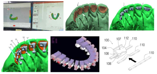 3D 시뮬레이션을 통한 최적 교정설계 과정