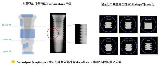 임플란트 미들파트의 class 분류 예제