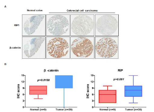 대장암 조직에서 RIP1과 β-catenin의 발현 증가
