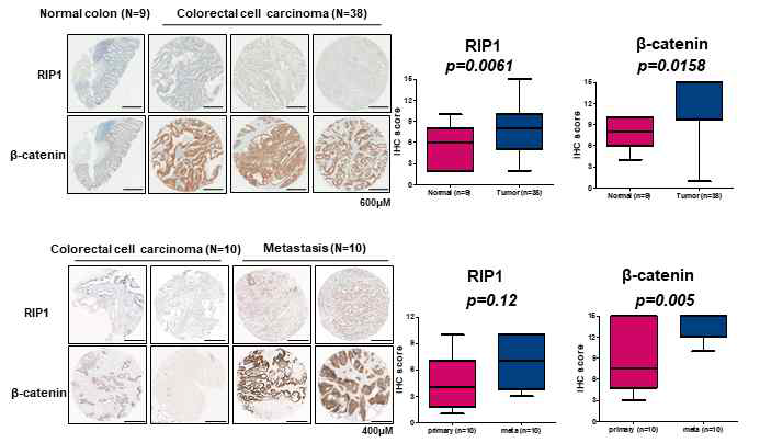 임상에서 RIP1과 β-catenin의 발현 연관성