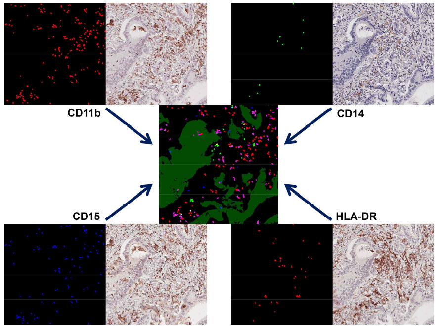 CD11b항체에 의해 DAB염색된 부분을 인위적으로 red color를 입혔고, CD14항체로 염색된 부분은 밝은 green color를 입혔음. 또한, CD15항체로 염색된 부분은 blue color로 하였고, HLA-DR로 염색된 부분은 pink color로 입혔음. Cytokeratin항체로 염색된 상피세포부분은 green color를 입혔다. 이를 overlap하여 중앙의 그림을 완성하였음