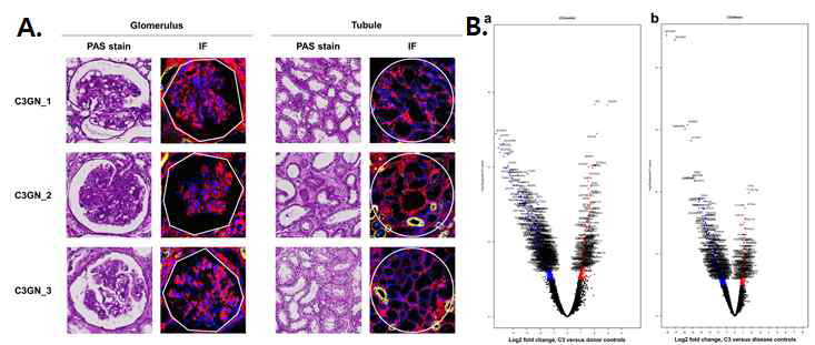 A. Spatial transcriptomic analysis에 활용된 glomeruli 와 tubule 이미지, B, 정상 및 질병대조군과의 DEG의 volcano plot (unpublished data)