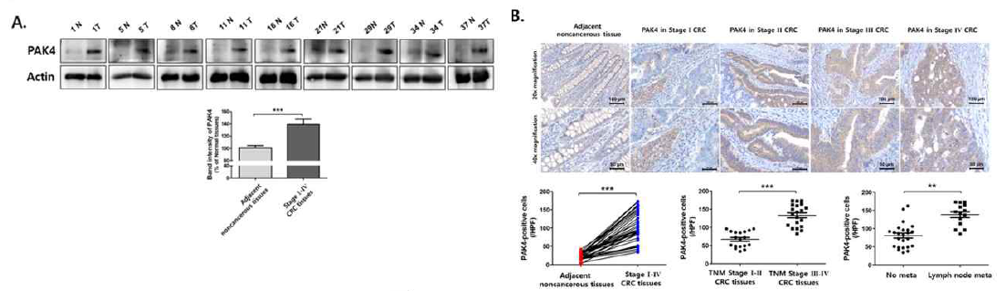 대장암 환자에서 정상조직 대비 암조직에서 PAK4 발현 상승 확인 38명의 대장암 환자조직 중 8명의 조직을 분쇄하여 웨스턴 블로팅 시행. 그 결과 대장암 인접 정상 조직에 비하여 암조직에서 PAK4 발현이 의미있게 상승하였으며 early stage보다 late stage에서 PAK4 발현이 높으며 림프절 전이가 있는 환자에서 높은 PAK4 발현 양상 확인. 이를 통해 PAK4가 대장암 생성과 진행 전이 예후까지 예측할수 있는 바이오마커임을 규명