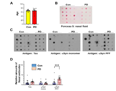 콧물액에서의 병변 단백 질 결합 항체 정량. (A) 콧물액 샘플 채위 정상군 (Con, 20명), 파킨슨 환자군 (PD, 15명)의 나이 분포 (B) 콧물액을 printing한 nitrocellulose membrane에 대한 ponceau 염색 (C) 각 항원 재조 합 단백질 (Tau, a-synuclein, α -synuclein preformed fibril, 5 ug each)에 대해서 콧물액의 항 체를 이용한 dot blot assay (D) 각 항원에 대한 콧물액 샘플별 dot blot 신호 세기를 ponceau 콧물액 전체 단백체 양으로 나누 어서 normaliz한 값을 막대 그래 프로 표현함