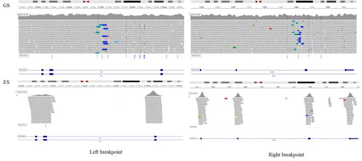 Whole-genome sequencing을 이용하여 결국 환자에서의 난청 원인은 large inversion임을 확인함