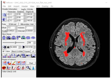 MRI WMH segmentation process