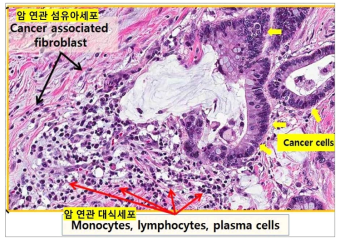 실제 환자의 종양 조직의 H&E 염색 결과