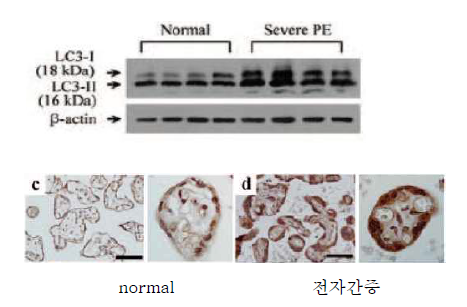 normal과 전자간증 태반에서 LC3 발현