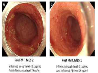 FMT 전 후 내시경 소견의 호 전과 항약물항체의 농도가 감소되고 약물의 최소 농도가 측정가능하게 변화됨