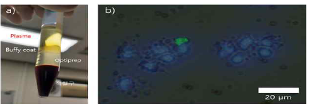 a) Optiprep을 이용하여 암환자의 백혈구(암세포)분리 b) 분리한 buffy coat를 형광염색 하여 백혈구(암세포)확인 (blue:세포핵)