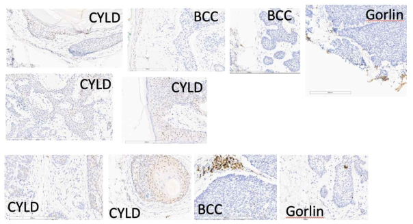 CYLD 돌연변이를 동반한 Brooke-Spiegler환자의 종양조직에서만 특이적으로 염색하는 IHC 마커 규명 (CYLD=Brooke spiegler 환자에서의 종양조직; BCC=정상환자에서의 기저세포암 조직; Gorlin= Gorlin증후군 환자에서의 기저세포암 조직)