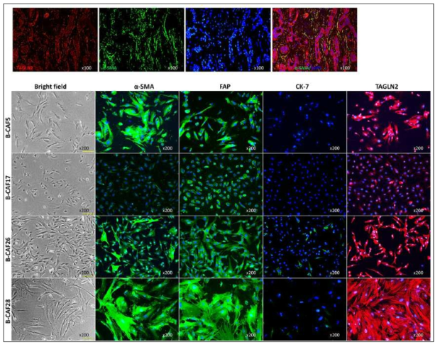 환자 조직(上) 및 환자 유래 CAF (下)에서 TAGLN2 와 CAF 마커인 aSMA, FAP 의 발현을 비교하여 TAGLN2 가 CAF에서 발현함을 확인함