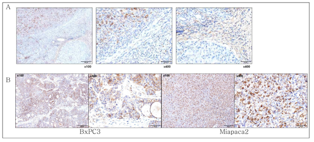 in vivo model tumor 에서의 GSN 발현 IHC. A. syngeneic orthotopic Pan02 tumor, B. Bxpc3 & Miapaca2 xenograft tumor