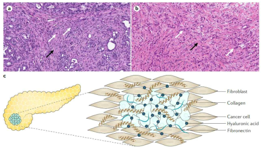 췌장암 desmoplastic reaction 조직 사진 및 모식도. a,b) 췌장암 환자 조직의 H&E 염색 사진. 췌장암 세포 (흰색 화살표) 주변을 다량의 섬유화조직이 (검은색 화살표) 둘러싸고 있음. c) 췌장암 세포를 둘러싸고 있는 섬유화세포 및 섬유화 조직으로 구성된 종양미세환경 모식도