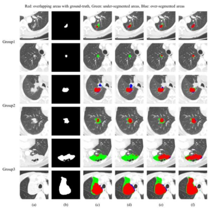 종양 분할 결과 가시화 (a) 원영상, (b) Ground truth, (c) U-Net (d) U-Net with multi-scale module, (e) U-Net with multi-scale dual-attention module (f) 제안방법