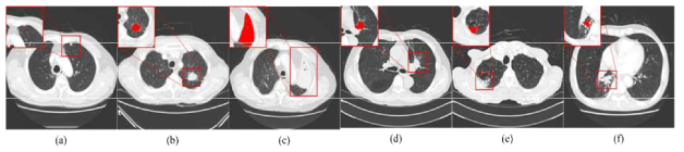 다양한 크기, 서로 다른 위치와 형태를 가진 폐암의 예 (a) 작은 크기 종양 (b) 중간 크기 종양 (c) 큰 크기의 종양 (d) 종격동 부착 종양 (e) 흉벽 부착 종양 (f) 혈관 부착 종양 (빨간색: 폐종양)