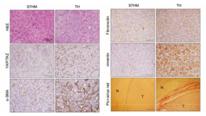 YAP/TAZ 가 활성화가 다른 두 간암 모델 (S7HM 과 TH 모델)에서 나타나는 기질 활성도의 차이. YAP/TAZ 가 활성화된 TH 모델이서 기질활성을 유발시키는 세포인 Hepatic stellate cell (HSC) 표지자인 alpha smooth muscle actin (a-SMA) 단백질 발현 증가를 확인하였고 또한 기질활성 표지자인 collagen 과(Picro-sirius Red staining) Vimentin 발현도 TH 모델에서 증가했음을 확임함