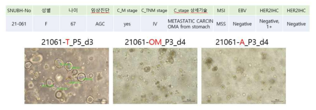 동일 환자의 원발조직(T), omentum 전이 조직(OM), 복수(A)에서 수립된 오가노이드 사진
