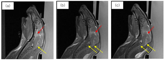 Post-BBB opening (a) and Post-BCB opening CeT1 Images (b, c). (a) BBB-opening 이후에 MR영상신호가 증가되는 현상(빨간색 화살표)이 나타나기는 하나 Cisterna magna와 척수부분에서의 영상신호 (노란색 화살표) 증가는 나타나지 않음. (b) LV를 target으로한 BCBopening 직후 MR영상신호의 증가가 보다 두드러지게 나타나며, Cisterna magna에서의 신호증가가 약하게 나타남. (c) BCB opening 후 40분 경과시 MR영상신호가 증가된 면적이 확대되었으며, Cisterna magna와 척수액부분에서의 신호증가가 관찰됨